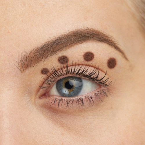 A close-up of a person's eye with big, dark dots above the eyebrow.