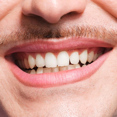 A close-up of a person's smiling mouth with visible teeth and a mustache.