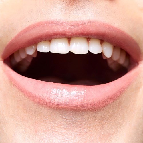 A wide open mouth shows missing and crooked teeth, with pink lips and clear skin.