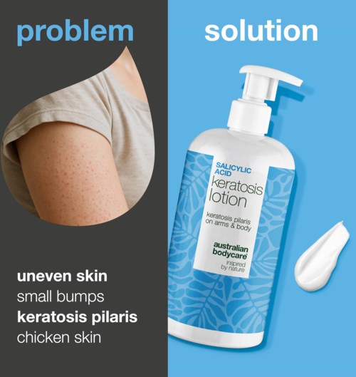 Zeigt Haut mit Unebenheiten und kleinen Beulen neben einer Lotion gegen Keratosis pilaris.