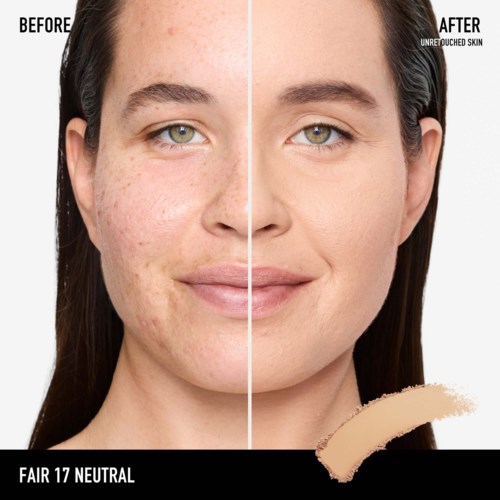 A woman's face shows a clear difference: one side with acne scars, the other smooth and clear skin.