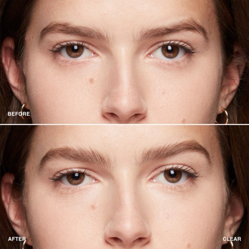 The image shows a woman's face in a before and after comparison, focusing on clear skin and fewer blemishes.