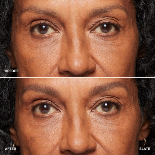 A woman's forehead, eyes, and cheeks appear smoother and more youthful in the after photo.