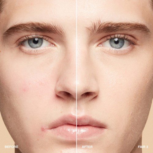 A split face showing clear skin after treatment, with some acne still visible on the left side.