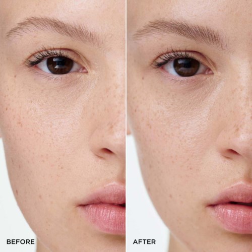 Side-by-side close-up of a young woman's face before and after clear skin treatment. Reduced freckles and smoother skin in the after image.