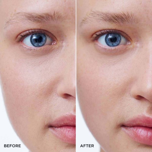 A woman’s face showing skin improvement after treatment, focusing on the eye, cheek, and lip areas.