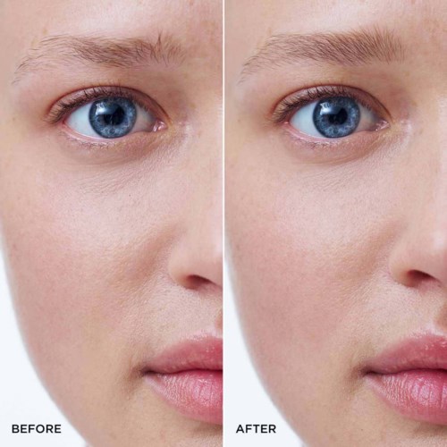 Close-up of a person's face showing before and after skin improvement near the eye, with smoother skin in the after photo.