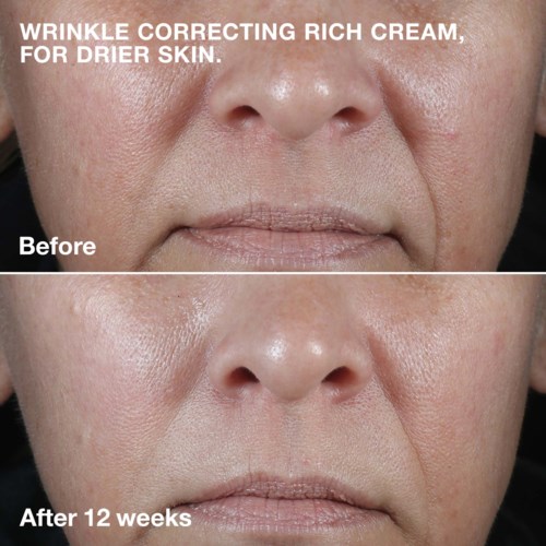Before and after photos show improved skin texture and less dryness after 12 weeks of cream use.