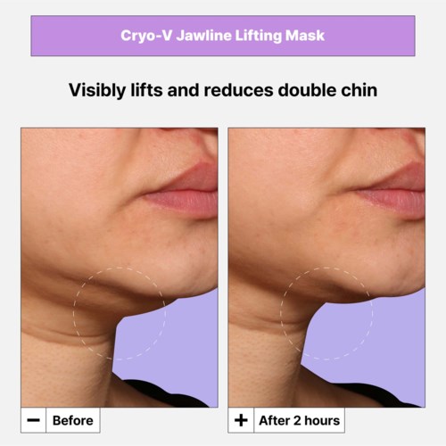 Sammenligning som viser dobbelthake før og etter bruk av Cryo-V Jawline Lifting Mask i 2 timer.