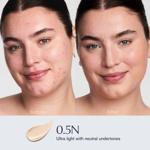 A woman's face shows clear skin after acne treatment, with smoother and brighter appearance, labeled 'Before' and 'After'.