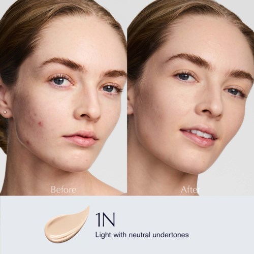 Comparison showing reduction of facial acne and clearer skin after using a product for skin lightening.