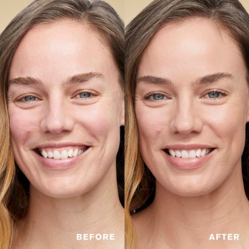 A woman with clear skin, smiling before and after skin treatment, showing improved skin appearance.