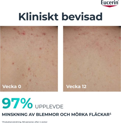 Twee huidfoto's vergelijken acne en donkere vlekken voor en na behandeling over 12 weken.