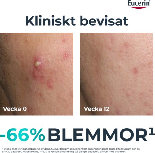 Jämförelse av hudens läkning, visar tydlig minskning av blemor från vecka 0 till vecka 12.