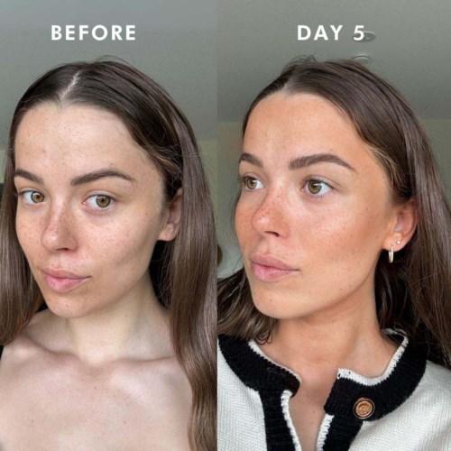 A woman shows clear skin improvement from before to day 5, with less acne and a more even tone.