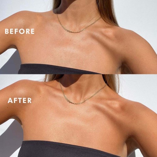 A before and after comparison showing skin tightening on the shoulder and neck area.