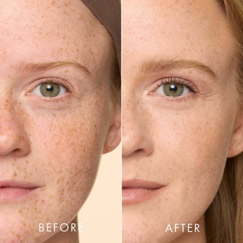 A side-by-side comparison of a person's face showing clear skin after skin treatment, focusing on freckles reduction.