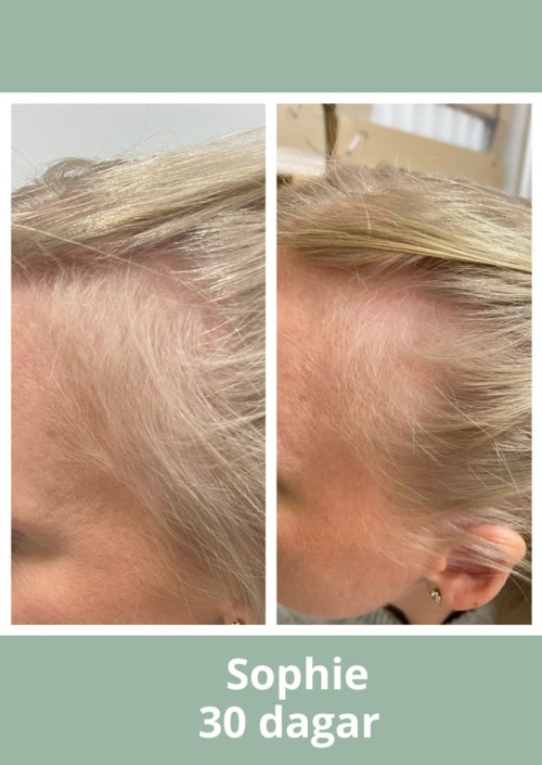 Side-by-side images of a woman's scalp before and after hair growth, showing improvement over 30 days.