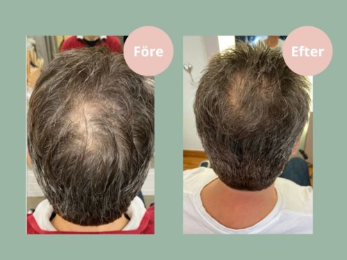Two photos show a person's head before and after hair growth treatment, with more hair in the second image.