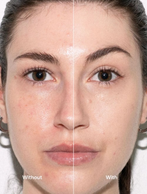 Side-by-side comparison of a woman's face showing acne and clear skin.