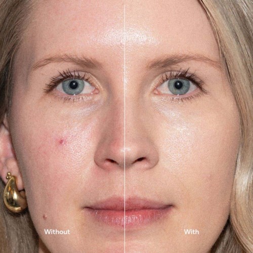 Comparison of a woman’s face showing skin with acne on the left and clear skin on the right.