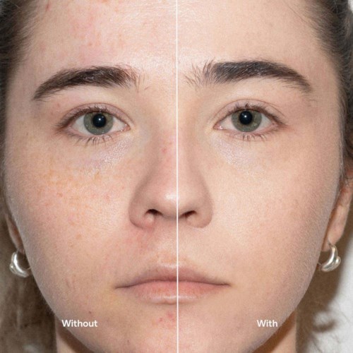 A side-by-side comparison of a woman's face showing skin with acne and clear skin after skincare.