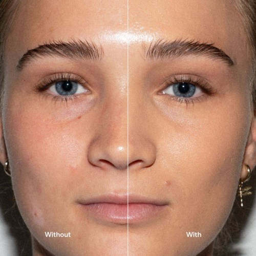 Split face showing skin with imperfections on the left and clear, smooth skin on the right.