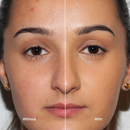 Split image showing a woman's face before and after skincare, with clearer, smoother skin on the right side.