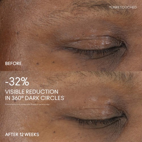 Close-up of a person's eye showing skin before and after 12 weeks of treatment, highlighting darker circles.
