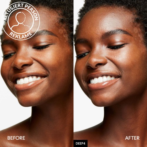 A woman's face before and after a cosmetic skin treatment, showing smoother, clearer skin.