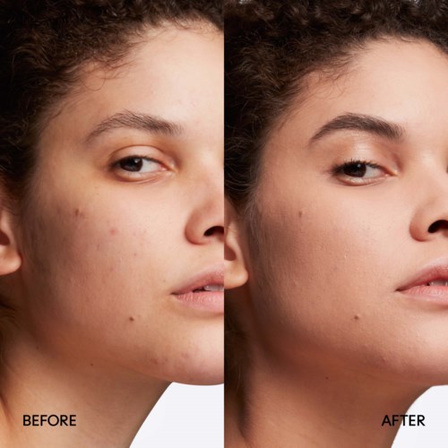 A side-by-side comparison showing skin improvements after treatment, with fewer pimples and smoother skin on the right.