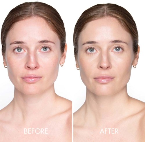 A woman shows a reduced appearance of skin blemishes and a more even skin tone in a before-and-after photo.