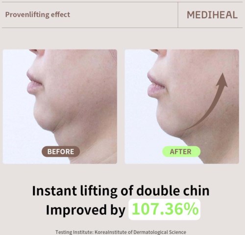Voor- en na-foto's van een lifting van de dubbele kin met 107,36% verbetering. Eenvoudige beschrijving zonder technische details.