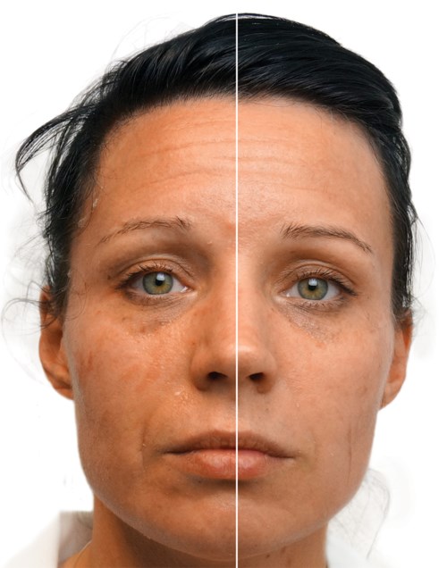 Side-by-side comparison of a woman's face showing before and after skin treatment results.