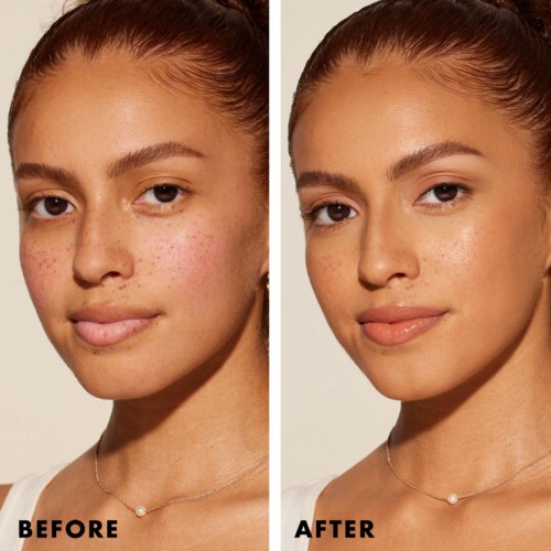 The image shows a side-by-side comparison of a woman's face before and after skincare. The 'before' side has acne and spots, while the 'after' side is clear and smooth.