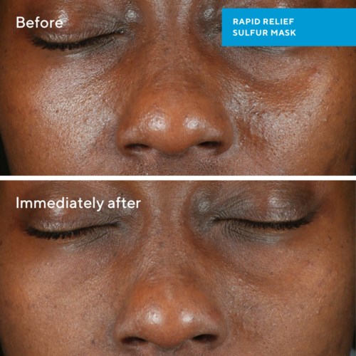 A face showing skin improvement after using a sulfur mask, with less redness and clearer skin.