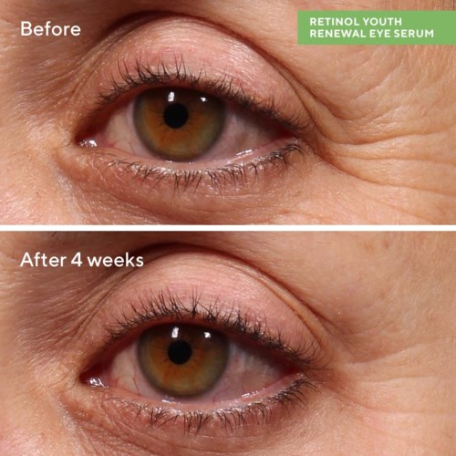 Zwei Bilder zeigen ein Auge, vor und nach vier Wochen Augenserum-Anwendung, mit verbesserten Haut um das Auge.
