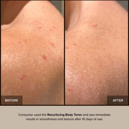 Vergelijking van huid voor en na het gebruik van Resurfacing Body Toner. Huid lijkt gladder en helderder na de behandeling.