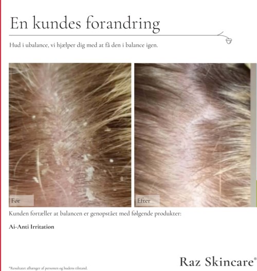 En hudvårdsprodukt hjälper till att förbättra hårbottnens hud, visar bilder före och efter avskallnad med mjäll och klart hårbotten.