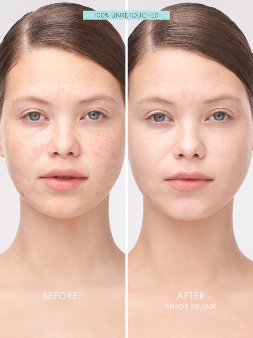 Comparison shows clear skin improvement after treatment, with fewer blemishes and a more even skin tone.